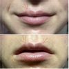 Hyaluron lässt sich nicht auflösen + weiße Stellen an den Lippen - 61404