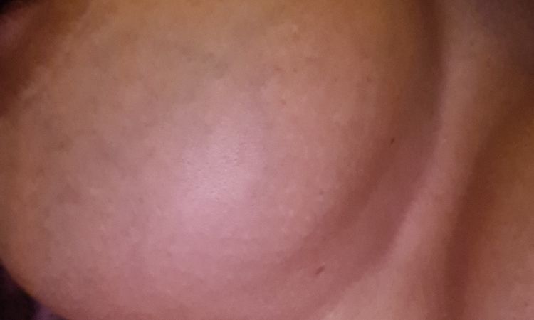 Lässt sich diese Brust korrigieren? - 61514