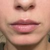 Rückbildung nach einmaliger Lip Filler Behandlung