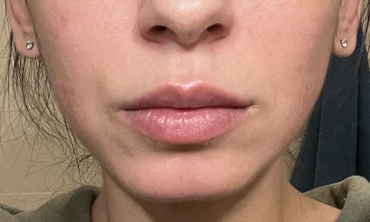 Rückbildung nach einmaliger Lip Filler Behandlung - 61646