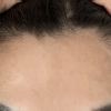 Haartansplantation nach Facelift