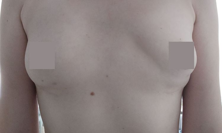 Muskeldeformierung nach Implantatentfernung - 61903