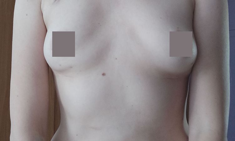 Muskeldeformierung nach Implantatentfernung - 61904