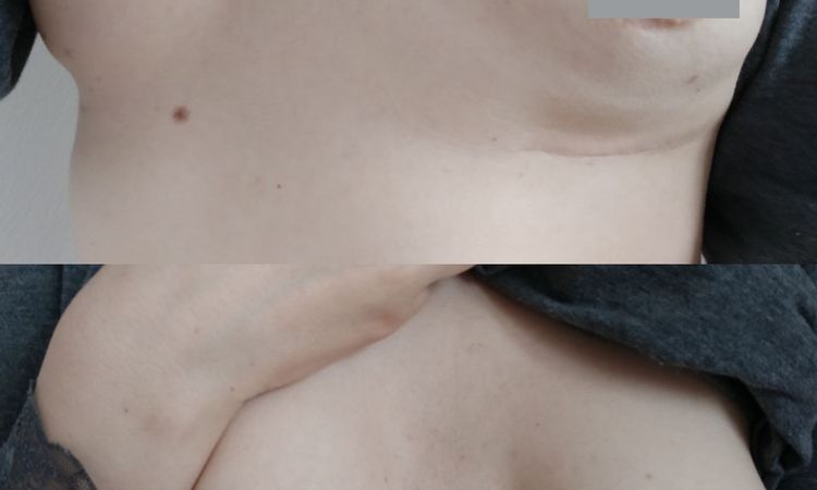 Muskeldeformierung nach Implantatentfernung - 61905