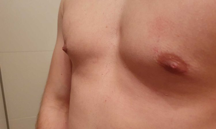 Gynäkomastie Korrektur schiefgelaufen? - 62474