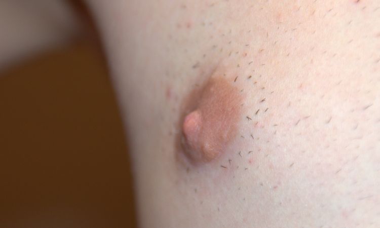 Gynäkomastie Korrektur schiefgelaufen? - 62482