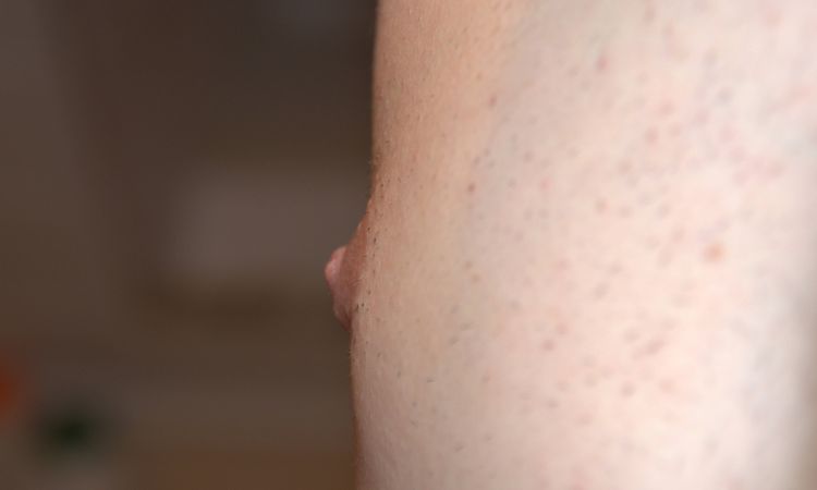 Gynäkomastie Korrektur schiefgelaufen? - 62483