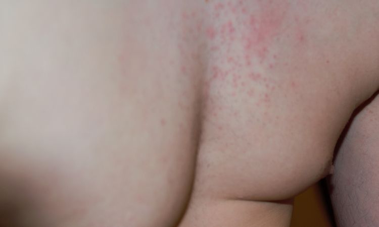 Gynäkomastie Korrektur schiefgelaufen? - 62486