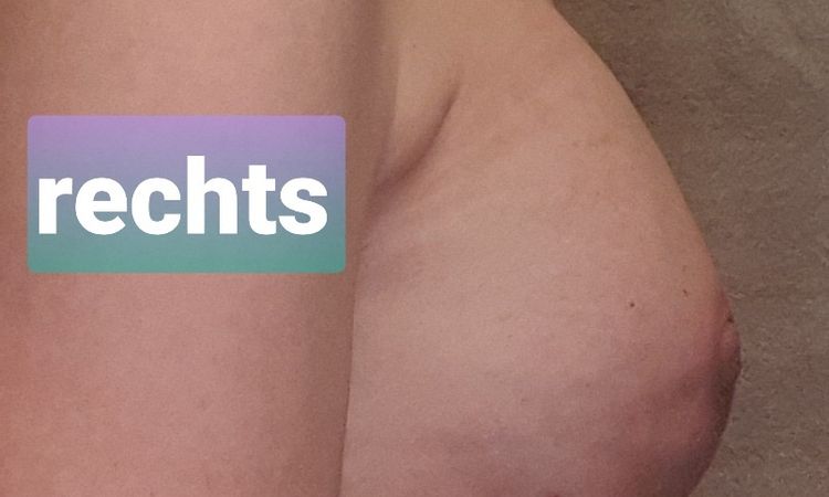 Implantatwechsel und Senkung - 62536