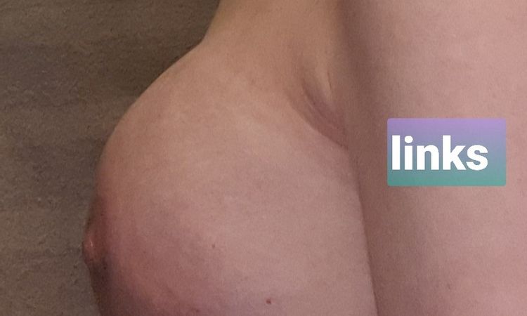 Implantatwechsel und Senkung - 62537