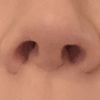 Korrektur asymmetrische Nasenspitze bei voroperierter Nase - Spezialist gesucht - 62743