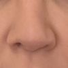 Korrektur asymmetrische Nasenspitze bei voroperierter Nase - Spezialist gesucht - 62744