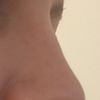 Korrektur asymmetrische Nasenspitze bei voroperierter Nase - Spezialist gesucht - 62745