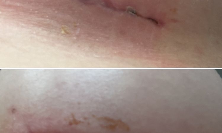 Wundheilung und Narben 5 Wochen nach Brustvergrößerung - 62784