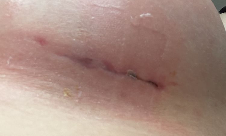 Wundheilung und Narben 5 Wochen nach Brustvergrößerung - 62785