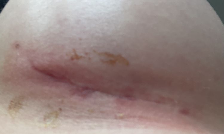 Wundheilung und Narben 5 Wochen nach Brustvergrößerung - 62786