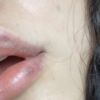 Weißer Fleck nach Lippenunterspritzung