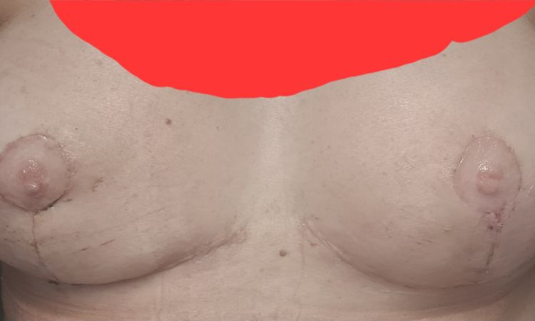 Delle nach Bruststraffung und Implatat - 62844