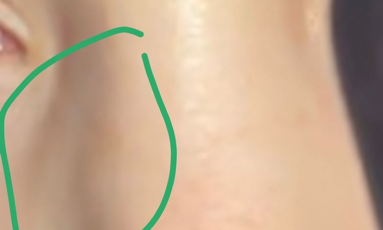 Knochen verrutscht nach OP? - 62851