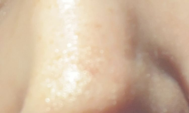Knochen verrutscht nach OP? - 62853