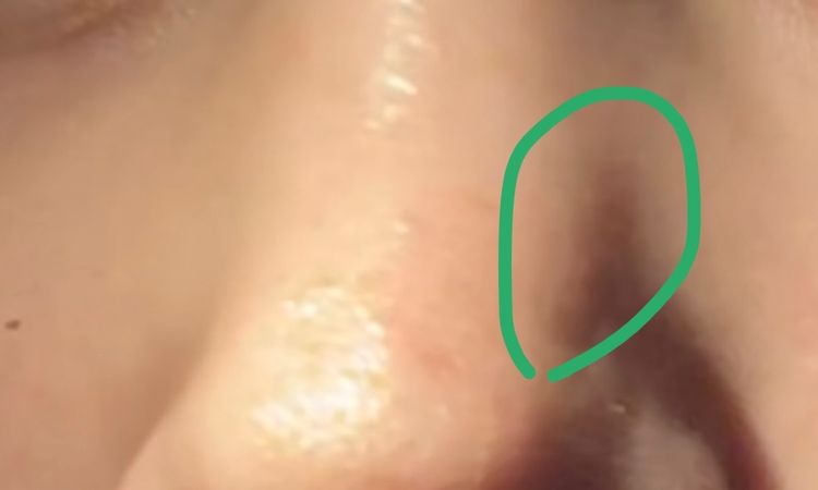 Knochen verrutscht nach OP? - 62854