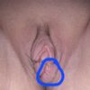 Schamlippenverkleinerung 9 Tage Post Op