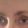 Endoskopisches Augenbrauenlifting / Hohlaugen - 62974