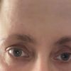 Endoskopisches Augenbrauenlifting / Hohlaugen - 62975