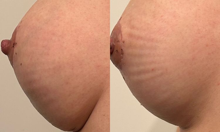 Implantat verrutscht, Bottoming out? - 63146