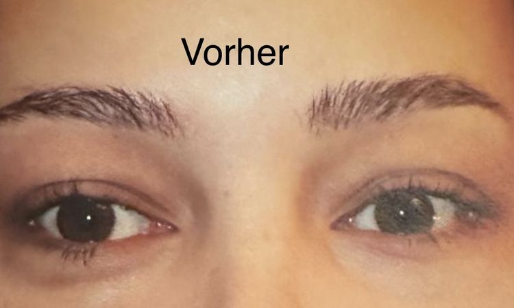 Augen sind unterschiedlich groß nach Oberlidstraffung - 63175