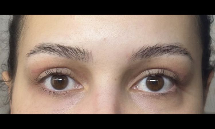 Augen sind unterschiedlich groß nach Oberlidstraffung - 63176