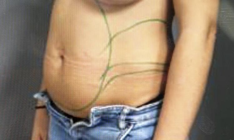 Falten und Dellen am Bauch nach Fettabsaugung - 63437
