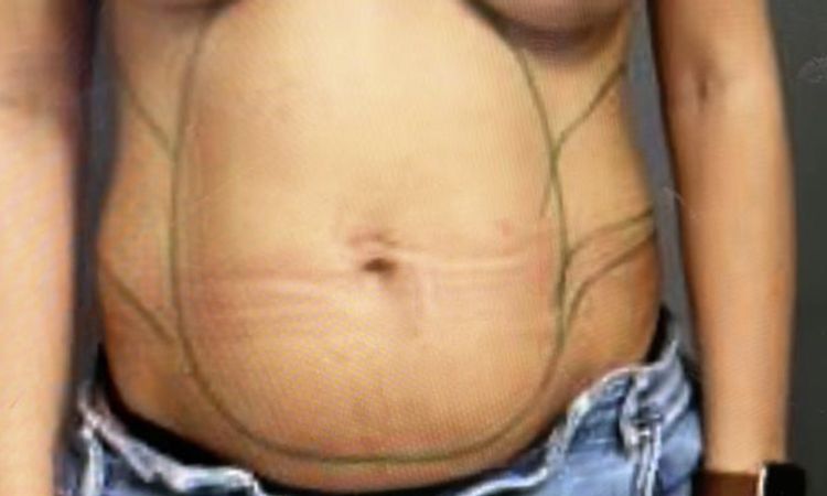 Falten und Dellen am Bauch nach Fettabsaugung - 63438