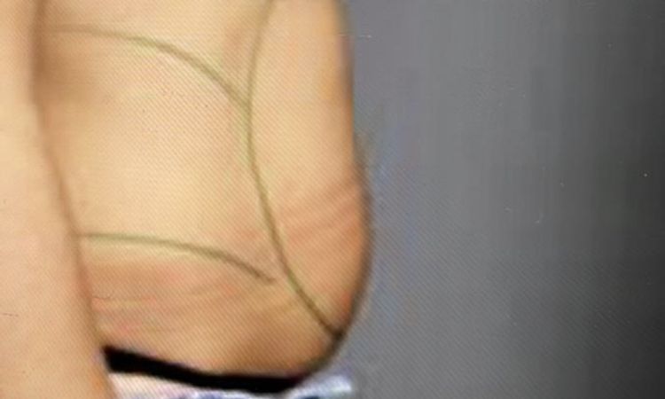 Falten und Dellen am Bauch nach Fettabsaugung - 63439