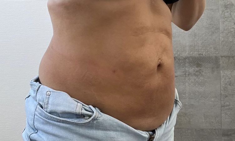 Falten und Dellen am Bauch nach Fettabsaugung - 63440