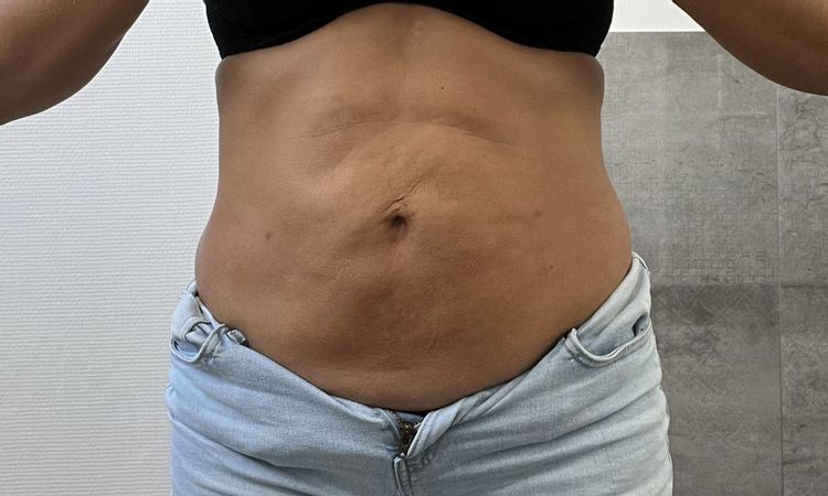 Falten und Dellen am Bauch nach Fettabsaugung - 63441