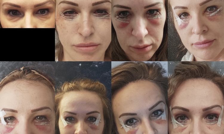 Unterlidstraffung Fettpolster nach einem Jahr - 63731