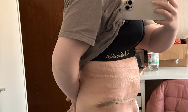 1 Woche Post OP / BDS,Lipo & BV - 63889