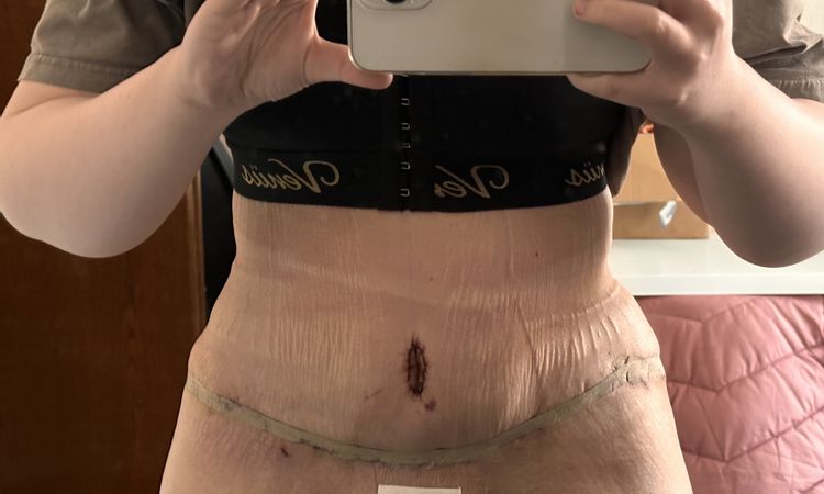 1 Woche Post OP / BDS,Lipo & BV - 63890