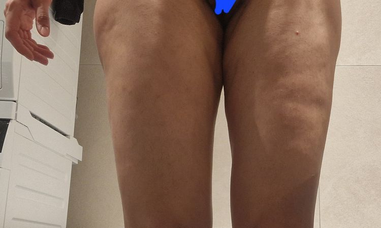 Lipo Revision Korrektur vornehmen - 63927
