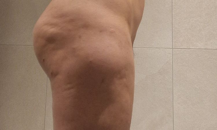 Lipo Revision Korrektur vornehmen - 63929