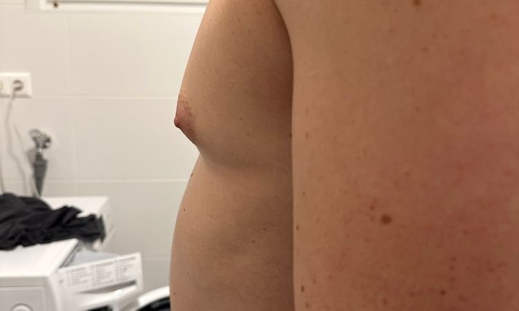 Meinungen zum Gynäkomastie OP Ergebnis - 64150