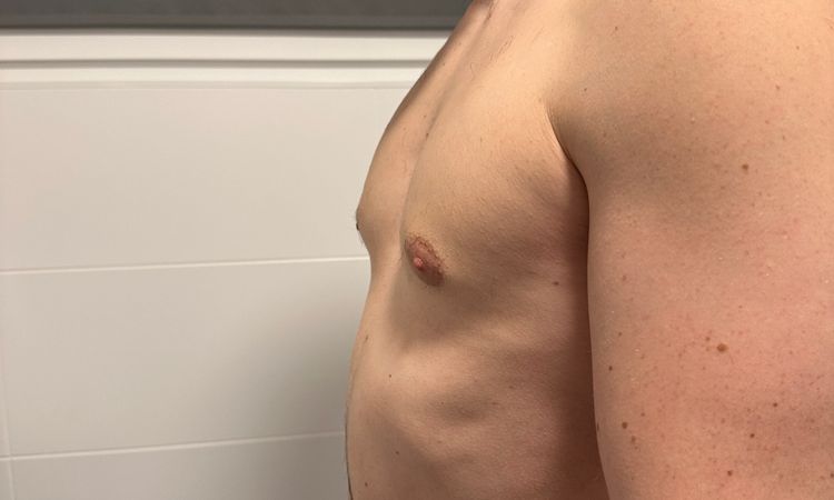 Meinungen zum Gynäkomastie OP Ergebnis - 64155