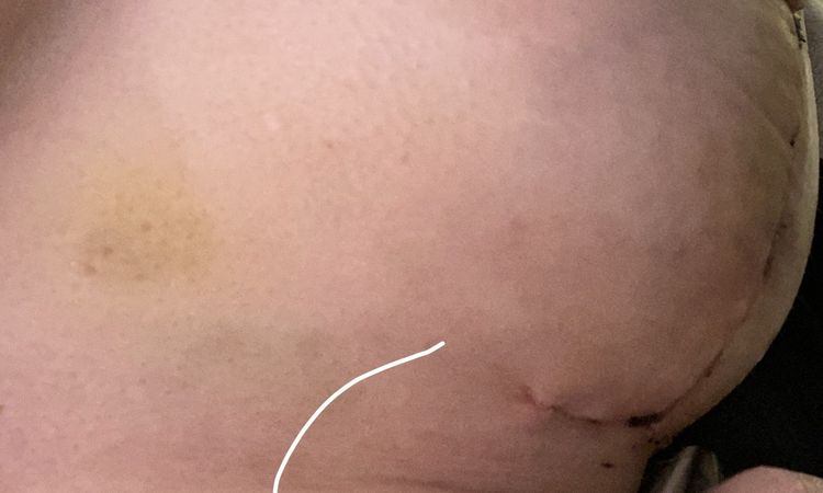 3 Wochen Postop - offene kleine Wunde auf senkrechter Narbe - 64239