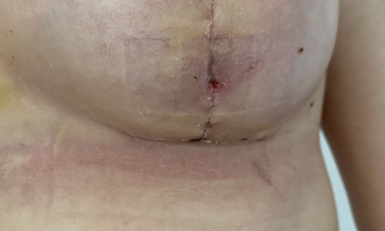3 Wochen Postop - offene kleine Wunde auf senkrechter Narbe - 64240