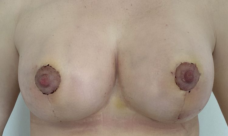 3 Wochen Postop - offene kleine Wunde auf senkrechter Narbe - 64241