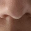 Asymmetrische Nasenlöcher und schiefe Nase nach OP - 64405