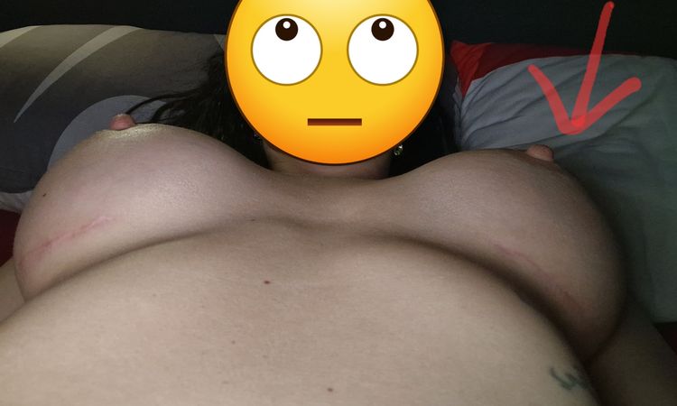 Brust rutscht einseitig weg 7 Wochen POST-OP - 64414