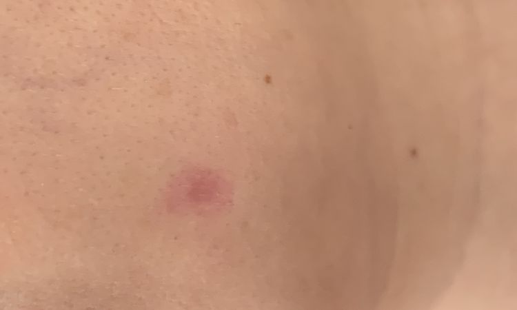 Narben Laser im Gesicht - 64458