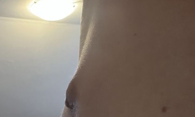 Spitze & Hervorstehende Brustwarzen nach Gynäkomastie OP - 64799